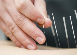 Docteur utilisant la méthode de l'acupuncture sur un patient