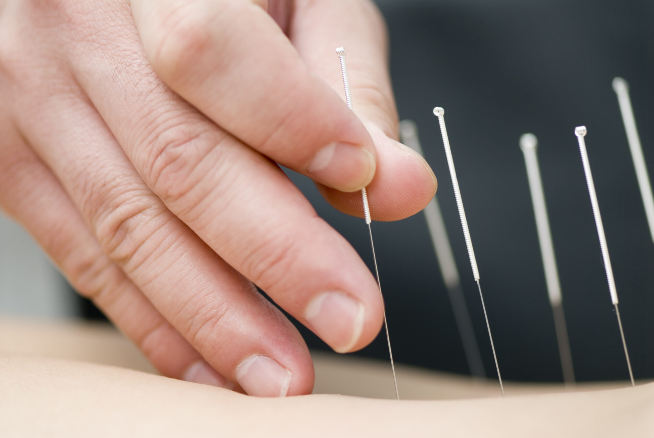 Docteur utilisant la méthode de l'acupuncture sur un patient